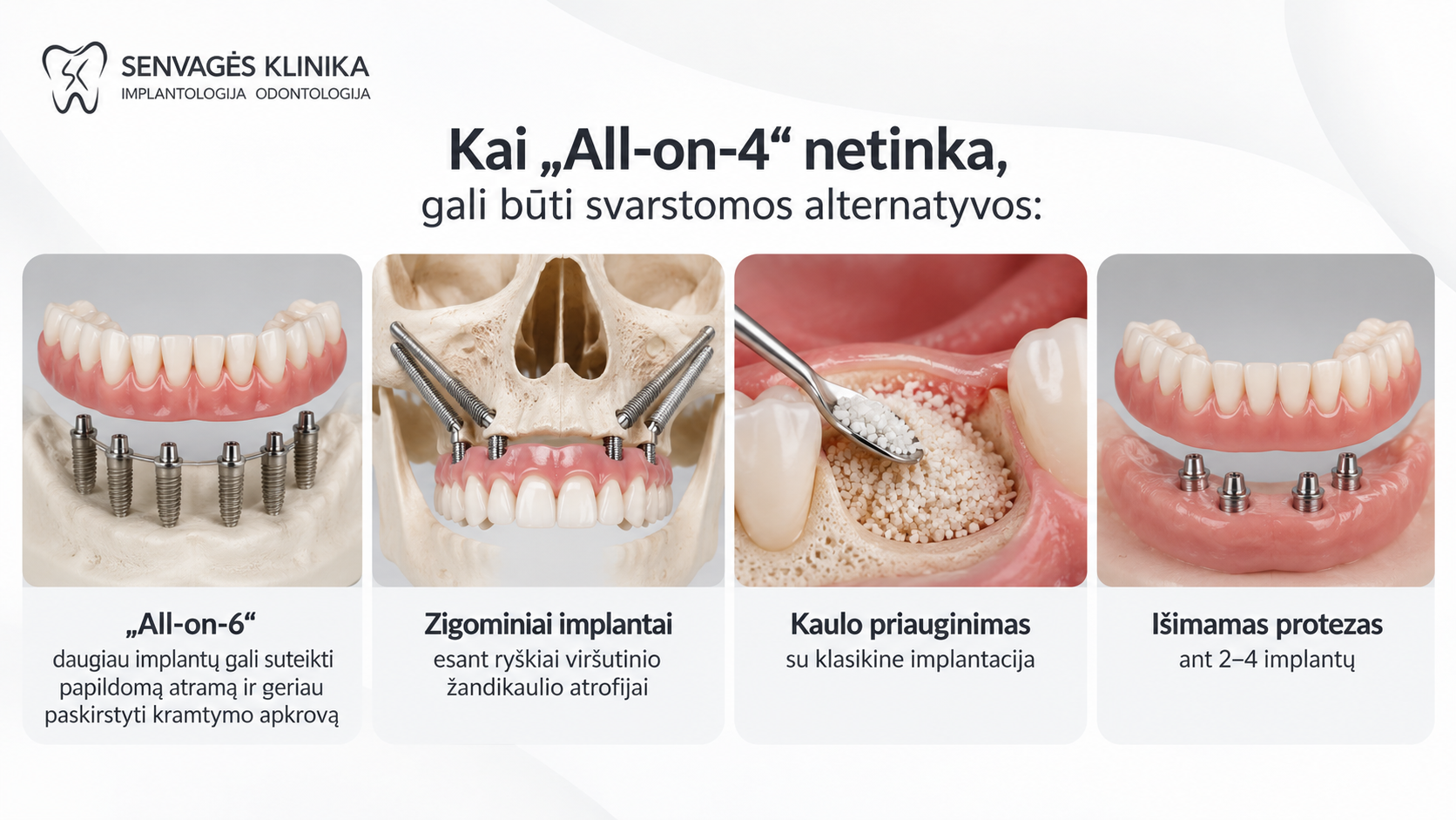 Infografika apie „All-on-4“ alternatyvas: „All-on-6“, zigominiai implantai, kaulo priauginimas su klasikine implantacija ir išimamas protezas ant 2–4 implantų.
