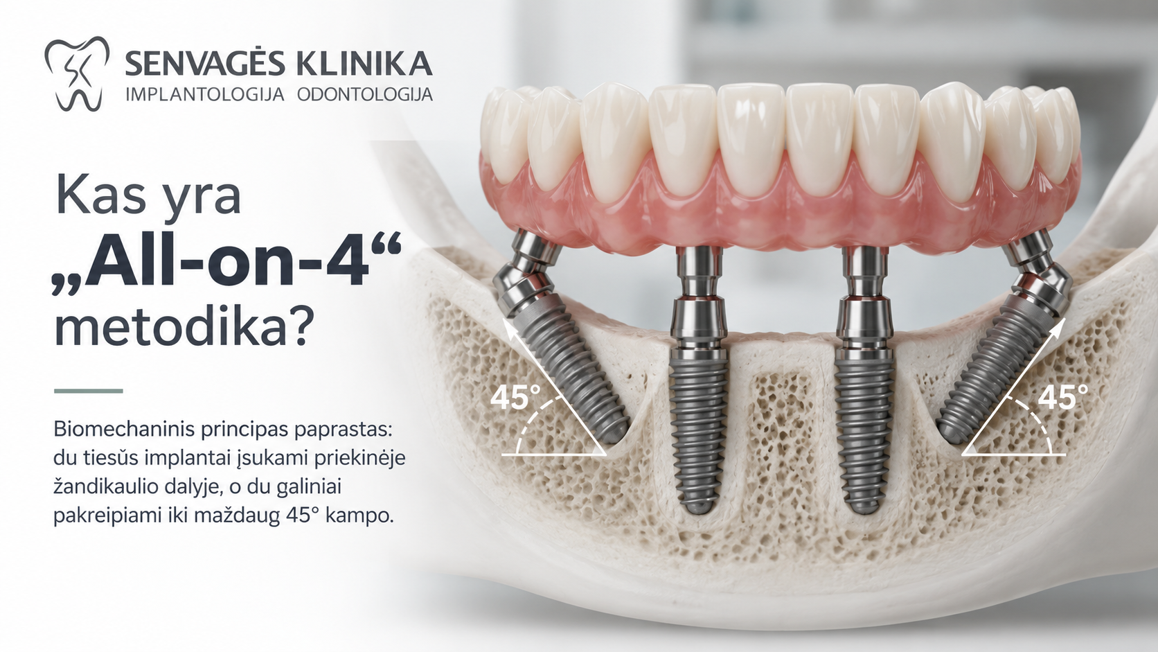 „All-on-4“ schema: du tiesūs priekiniai implantai ir du galiniai, pakreipti iki 45°.